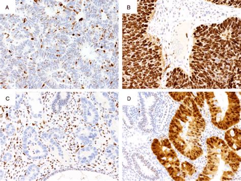 Different Patterns Of P53 Expression A Endometrial Endometrioid