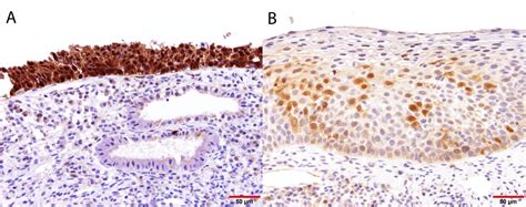 Pathology Of Cervical Carcinoma Glowm