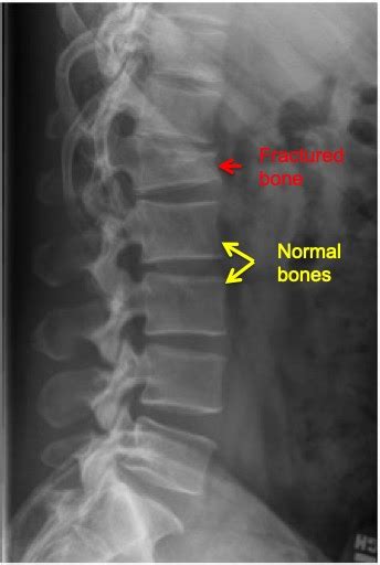 Osteoporosis And Spine Health Lubbock Amarillo Midland Sergiy