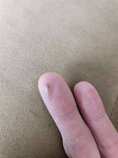 Itchy Fluid Filled Bump On Finger Started As Lump Under Skin Then