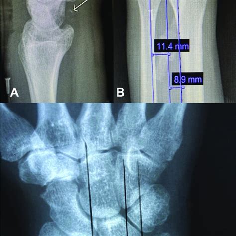 Plain Radiographs Of The Injured And Uninjured Wrist A Lateral View Of