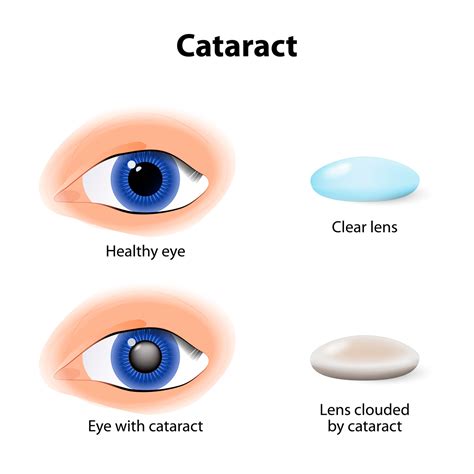 Cataract Surgery In Kansas City Mo Discover Vision
