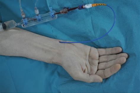 Radial Artery Versus Ulnar Artery Catheterization Thoracic Key