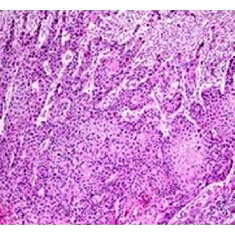 Pdf Appendix And Uterus Metastasis Of Squamous Cell Carcinoma Arising