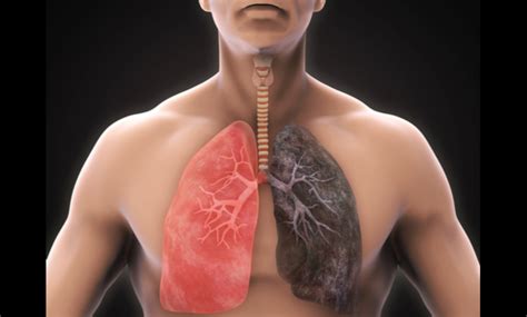 lung diseases caused by smoking every thing is here major diseases caused by smoking second hand