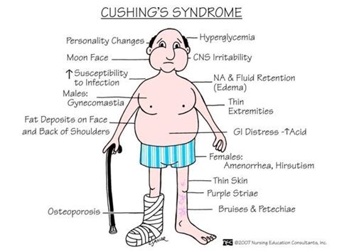 Cushings Syndrome Cushings Syndrome Nursing School Prerequisites