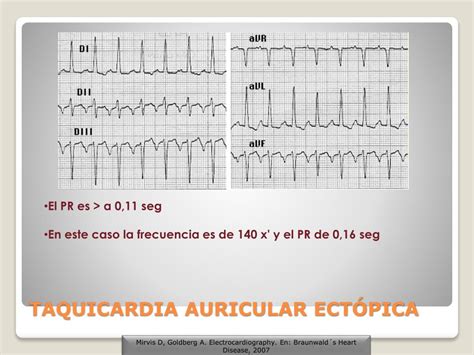 Atividade Ectópica Supraventricular Rara