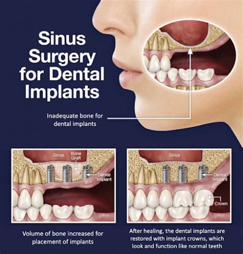 Important Things To Know About A Sinus Lift Dental Solutions