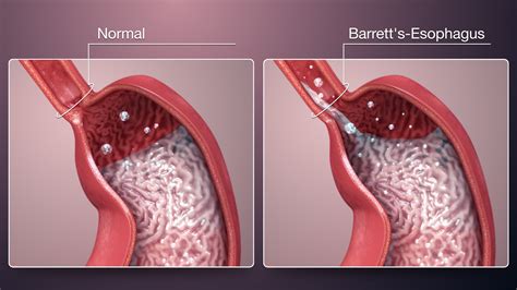 Barretts Esophagus Explained And Shown Using Medical Animation Still Shot