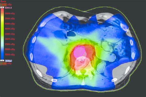 Dose Distribution Of Intensity Modulated Radiation Therapy Imrt