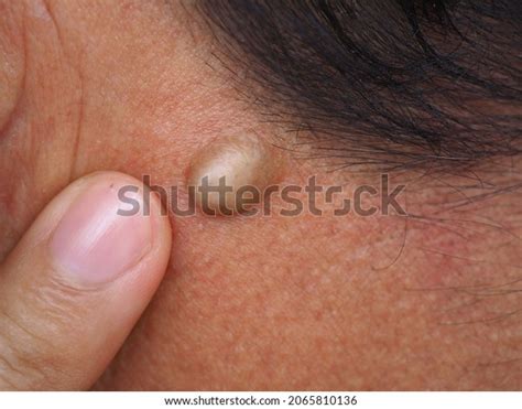 Man Pointed Sebaceous Cysts On His Stock Photo Edit Now 2065810136