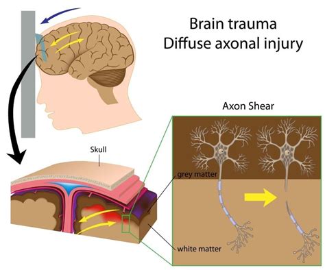 Learn About The Different Types Of Brain Injury With Premier Neurology
