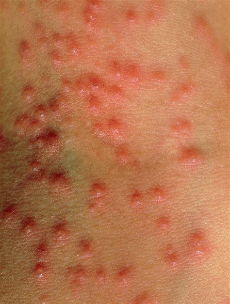 Close Up Of Vesicles On Skin Of Chickenpox Patient Photograph By