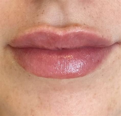 Is It Normal For Lips To Be Uneven Bruised And Swollen After Lip Filler