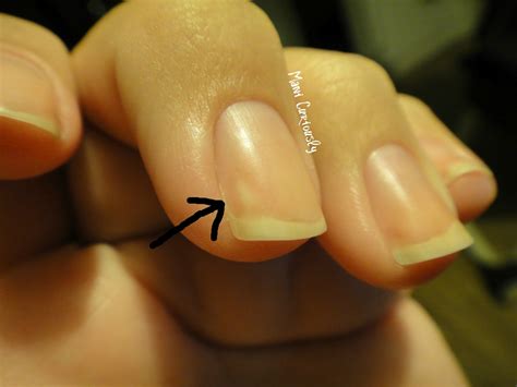 Mani Curiously Devastated Nail Fungus Is Among Us