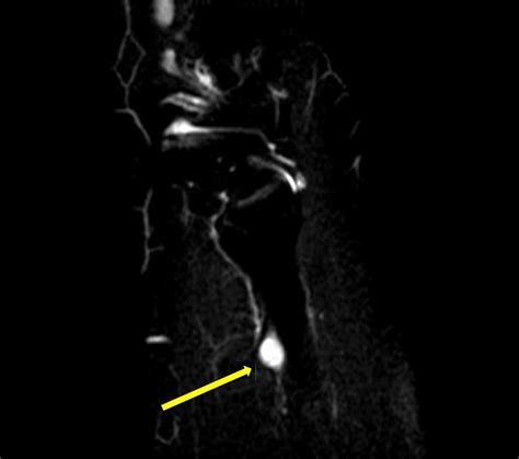 Superficial Peroneal Nerve Schwannoma Presenting As Lumbar Radicular