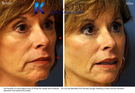 Facial Fat Transfer Before And After Gallery Dr Kolstad San Diego
