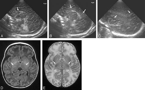 Cranial Ultrasound In Metabolic Disorders Presenting In The Neonatal