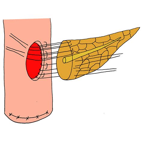 One Layered Technique The Pancreatic Anastomosis