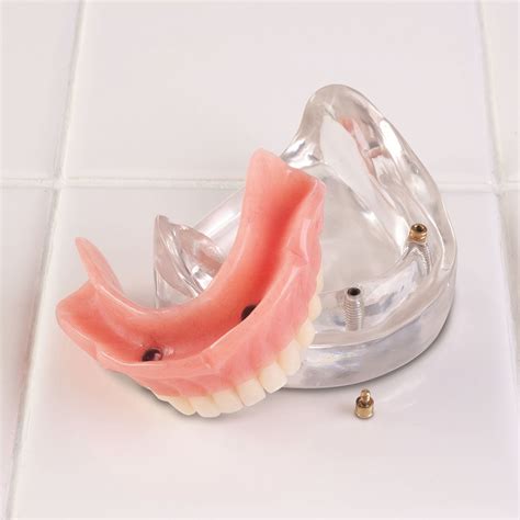 Loc 2 Lower Locator Two Implant Model Practicon Dental Supplies