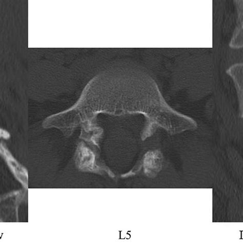 Ct Scans Showing Terminal Stage Spondylolysis At L5 In The Patients
