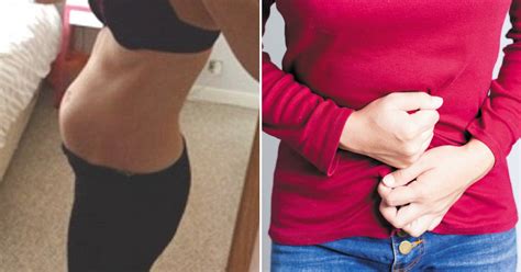 21 year old woman whose stomach was bloated for months discovered what took up most of her
