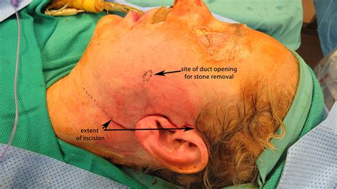 Combined Open And Endoscopic Removal Of Parotid Stone Sialendoscopy