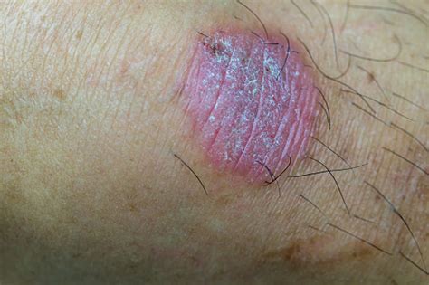 Foto De Infecção Do Semfim Do Anel Dermatophytosis Na Pele Infecção De