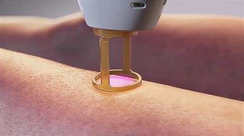 Laser Hair Removal Candela GentleMax Pro Medical Device 3D Animation