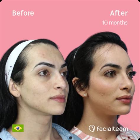 Julia S Before And After Ffs Surgery — Facialteam