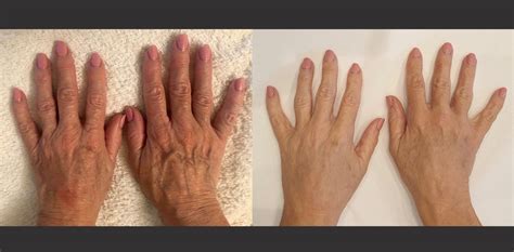 Hand Rejuvenation Treatment Hale Cheshire Med Fiore