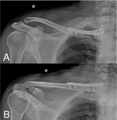 Figure 1 From Surgical Treatment For Fracture Of The Medial End Of The