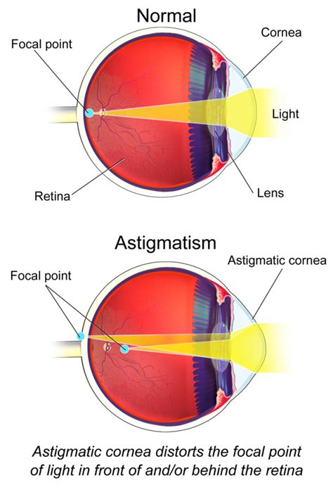 Astigmatism Foster Vision