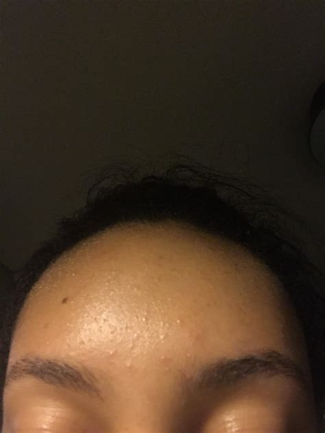 Small Bumps On Forehead General Acne Discussion Forum