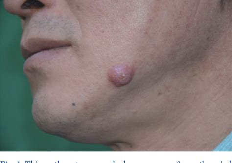 Figure 1 From Cutaneous Rosai Dorfman Disease Confused With Vascular