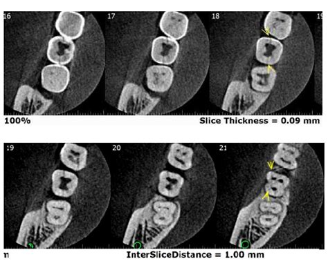 Cracked Tooth Diagnosis Root Fracture In Cbct