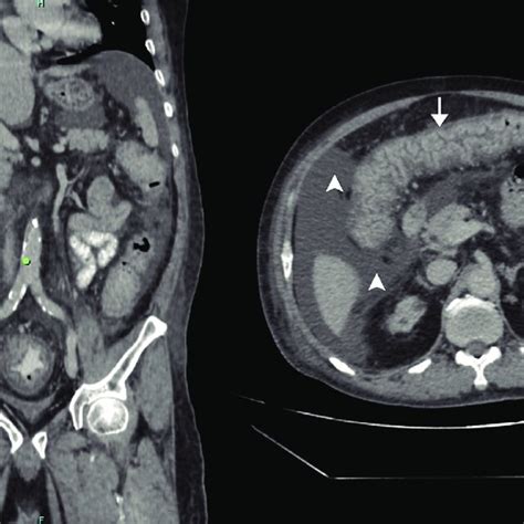 Abdominal Ct Scan With Intravenous Oral And Rectal Contrast Revealed
