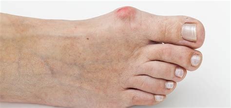 Juanetes o Hallux Valgus Todas las respuestas