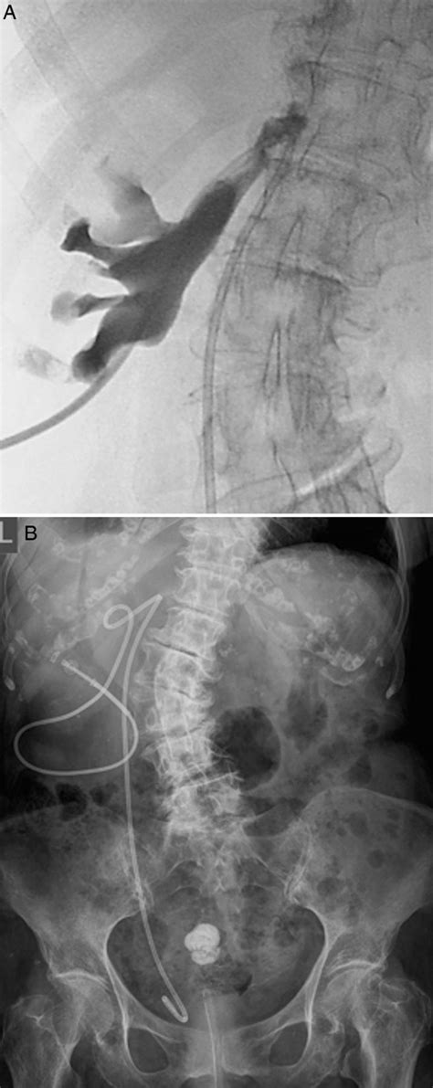 Right Sided Bochdalek Hernia Causing Septic Ureteric Obstruction