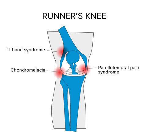 Runners Knee Runners Knee Treatment Recovery And Exercises Guide