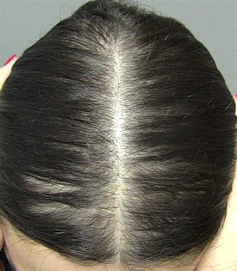 alopecia androgenetica dermatobrasiliacombr