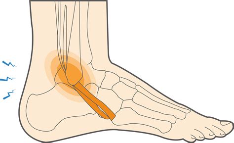 What Is Peroneal Tendonitis How To Manage Foot Pain Upswing Health