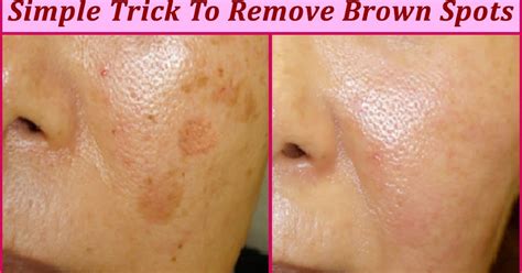 Simple Trick To Remove Brown Spots From Your Skin Top 5 Diy