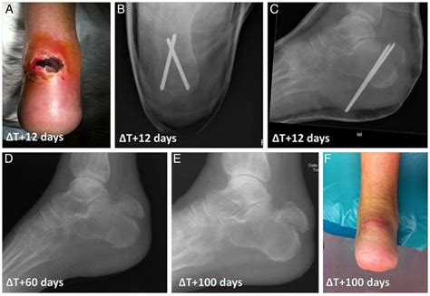 An Avulsion Fracture Of The Calcaneal Tuberosity Delay Of Treatment