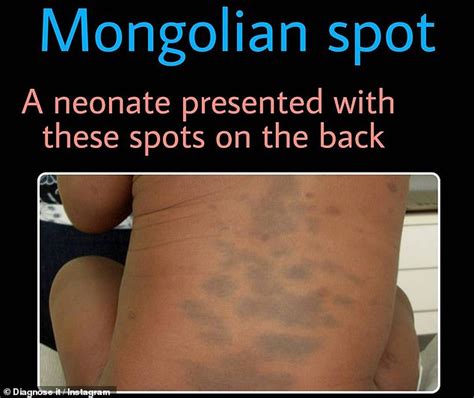 Mongolian Blue Spots Identification Causes And Risks My Xxx Hot Girl