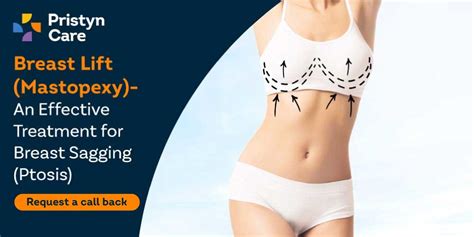 breast lift mastopexy an effective treatment for breast sagging ptosis pristyn care