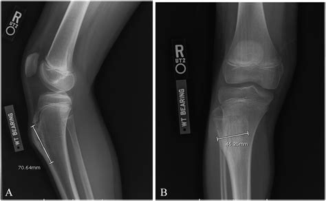 Osteochondroma Of The Tibial Tubercle Masquerading As Osgood Shlatter