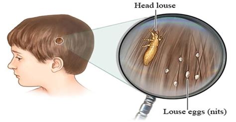 Experts Won't Reveal This Secret - How To Get Rid Of Head ...
