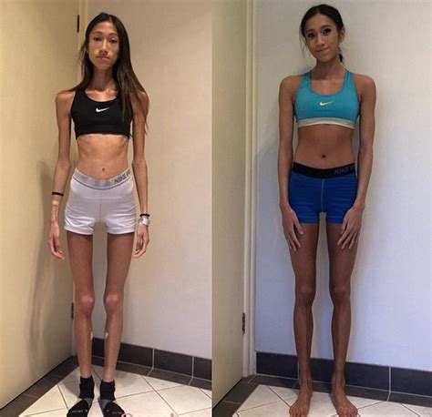 Medical Student Suffering Anorexia Nervosa Exercises Hours Daily Until Feet Comes Bleeding News
