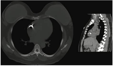 Coil Embolization To The Right Side Of The Heart After Elective